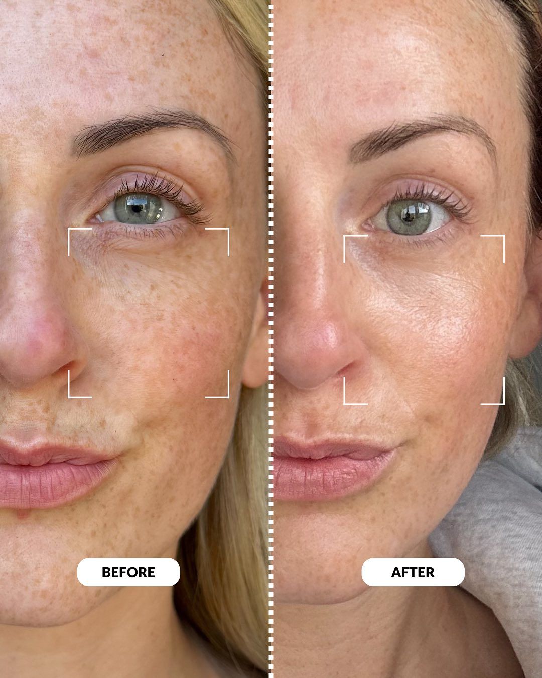 LED Therapy Face Mask